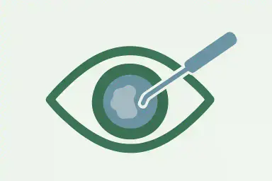 Cataract Surgery