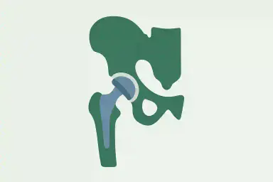 Hip Replacement